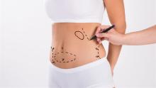 Liposuction Surgery Dubai