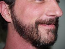 Beard Hair Transplant in Dubai