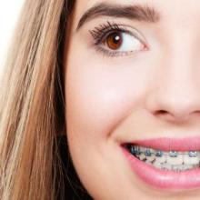 Dental Braces in Islamabad 
