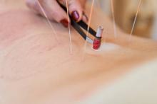 Acupuncture for Fertility Hertford ware