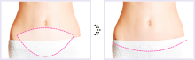 liposuction
