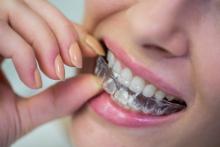 Invisalign in Edmonton