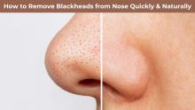 How to Remove Blackheads from Nose Naturally Quickly Permanently & Instantly