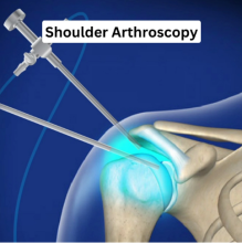 shoulder arthroscopy doctors in Kolkata