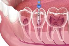 Root canal treatmen
