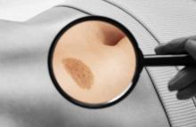 Birthmark removal in Dubai