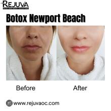 Expert Botox in Newport Beach