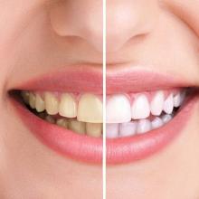 Milestone Dentistry Mississauga offers expert cosmetic dentistry and teeth whitening. Visit the best dental clinic in Mississauga for a confident smile.