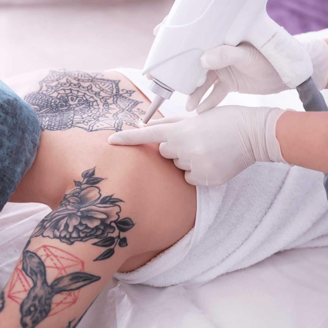 Laser Tatto Removal in Islamabad