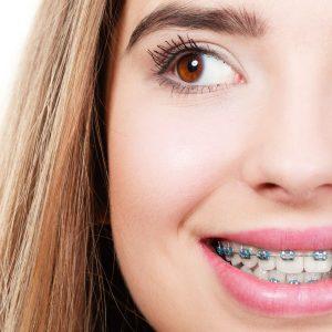 Dental Braces in Islamabad