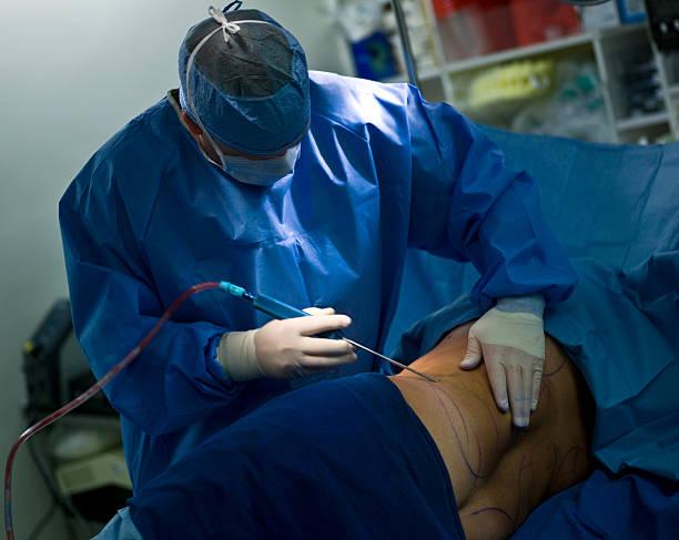 liposuction