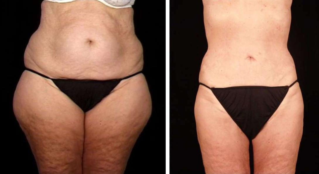 Laser Liposuction in Dubai