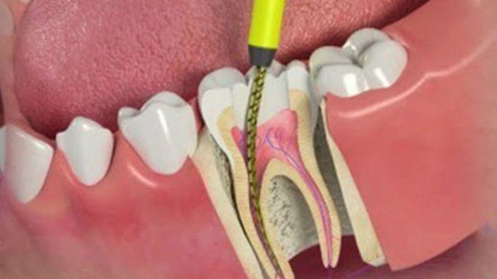 Root canal treatmen