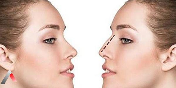 جراحة تجميل الأنف