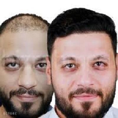 زراعة الشعر في الرياض