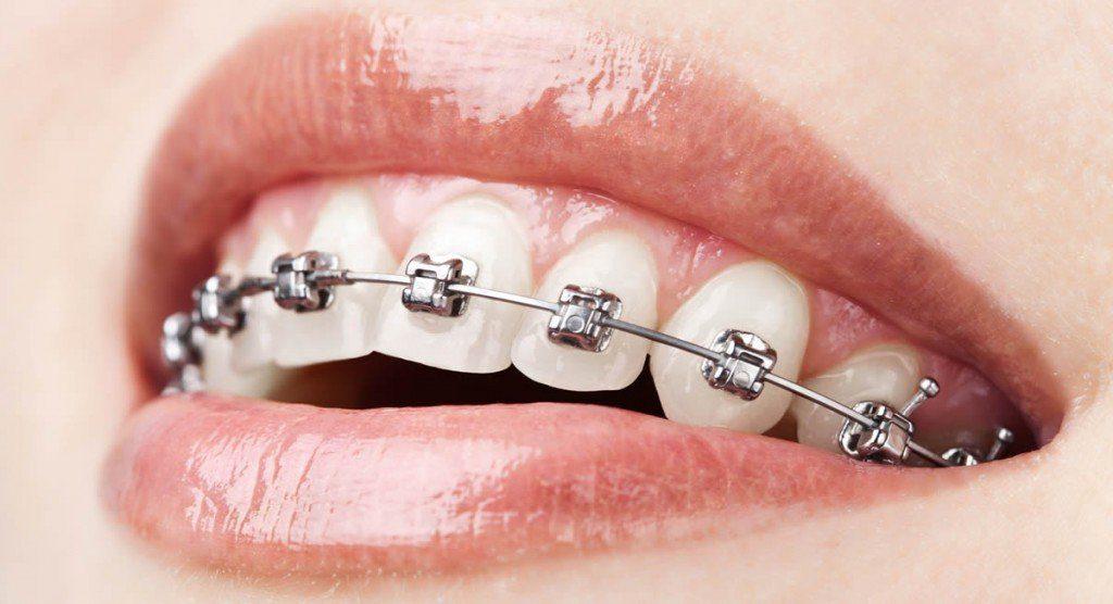 affordable braces Burbank