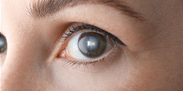 Cataracts can develop in different forms, and each type affects vision in its own way. From blurriness and glare to difficulty seeing at night, knowing the type of cataract is key to getting the right treatment. In this post, the Best Eye Surgeon & Ophthalmologist in Vaishali explains the main types of cataracts and how they impact your eyesight, helping you make informed decisions for clearer, healthier vision.