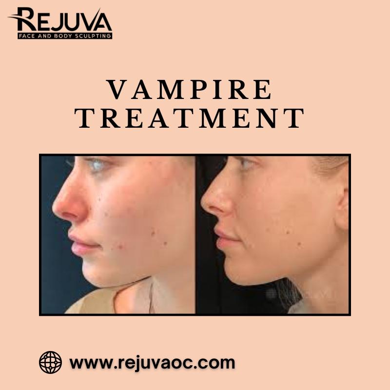 Vampire Treatment in Newport Beach