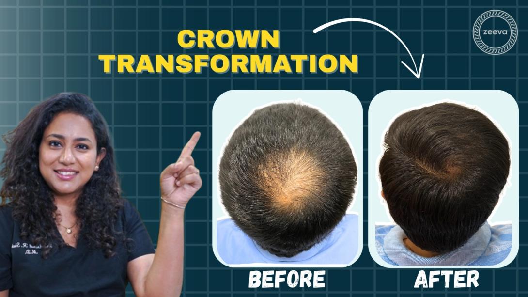 hair replacement without surgery