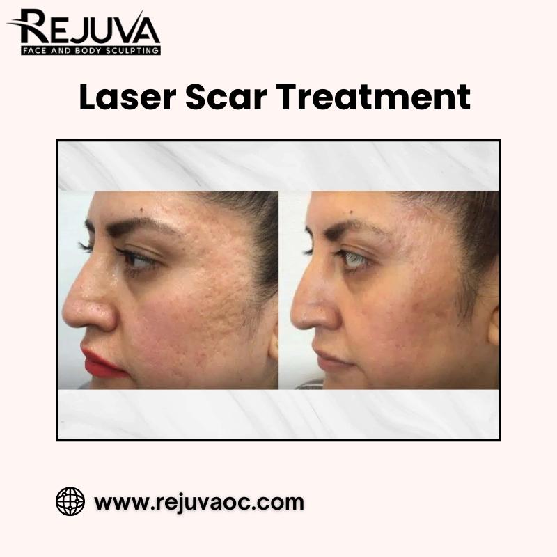 LaserScarTreatment, ExpertLaserScar, NewportBeachLaserScar, Rejuvaoc, NewportBeach,