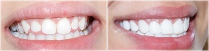 Composite Veneers Lebanon