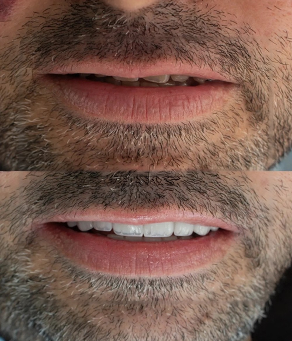 Dental Implants Lebanon, Veneers Lebanon, Composite Veneers Lebanon