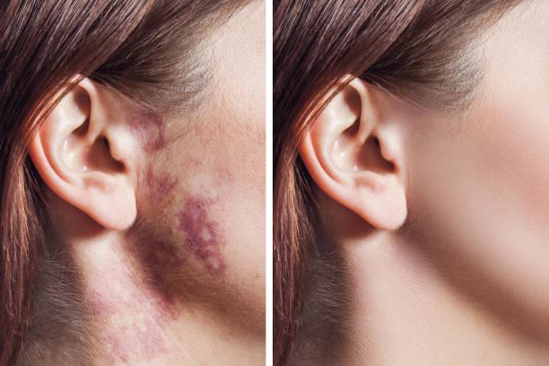 Birthmark removal in Dubai