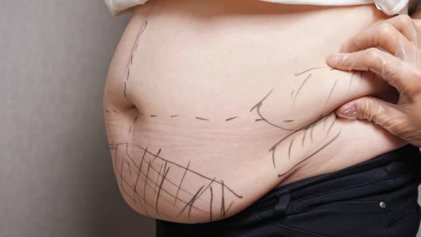 Circumferential Abdominoplasty in Dubai
