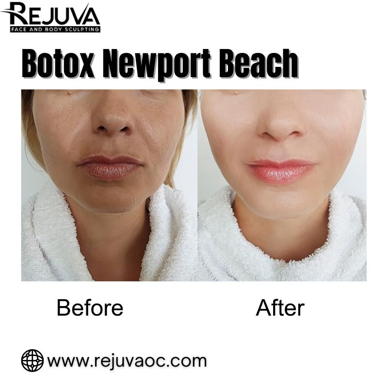 Expert Botox in Newport Beach