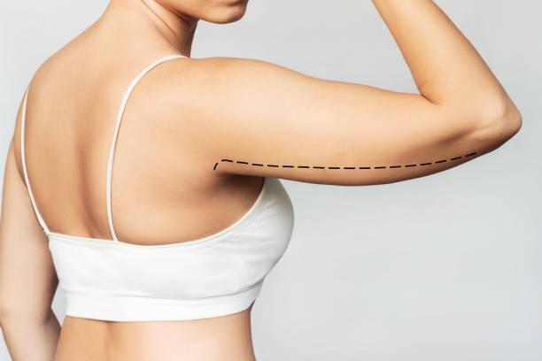 Liposuction in Dubai