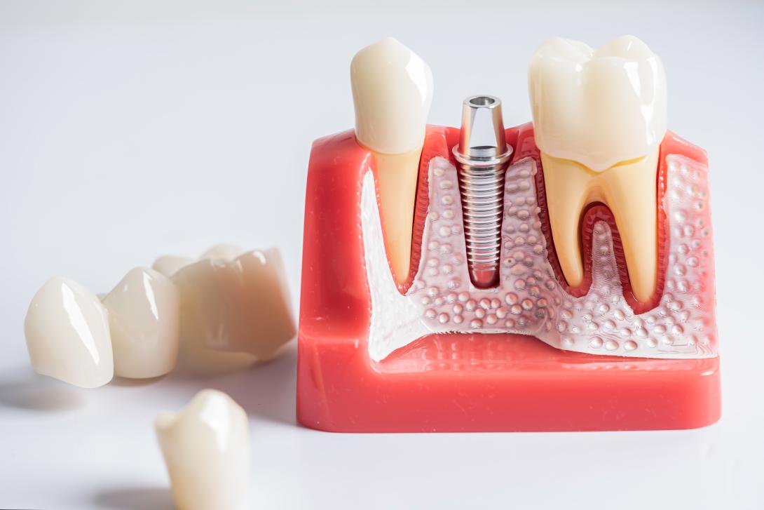 Why Dental Implants Are Better Long-Term Than Bridges